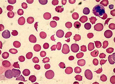 Sickle cell disease
