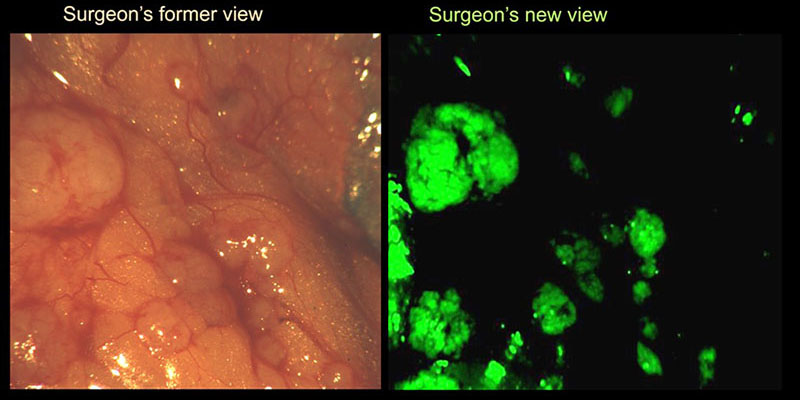 Fluorescence Guided Surgery of Cancer