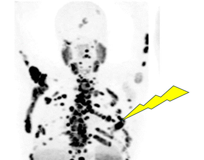 Tumor-targeted radionuclides