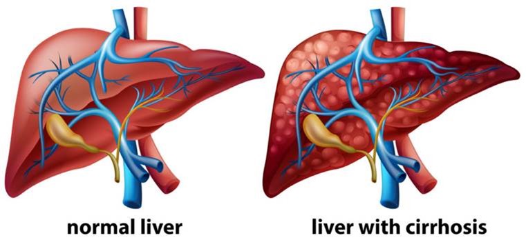 Illustration showing a normal liver and a liver with cirrhosis.