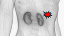 Possible transplant rejection