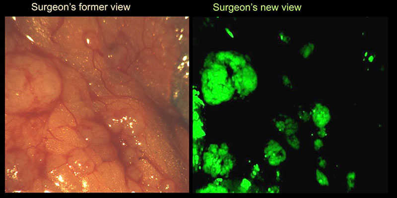 A surgeon's former view of tumors and the new view.